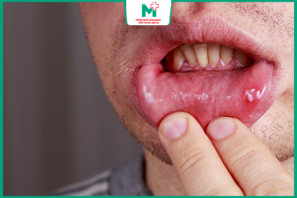bệnh chlamydia ở miệng