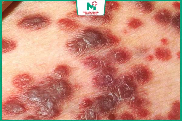 bệnh giang mai giai đoạn 3 