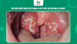 bệnh lậu ở họng