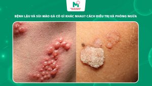bệnh lậu và sùi mào gà