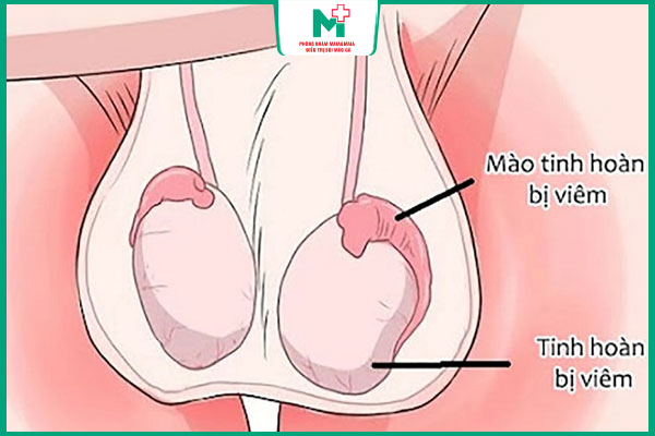 biến chứng giang mai