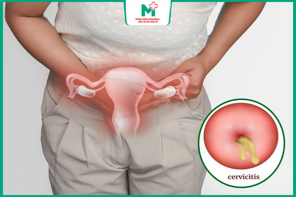 biến chứng viêm cổ tử cung