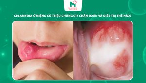chlamydia ở miệng