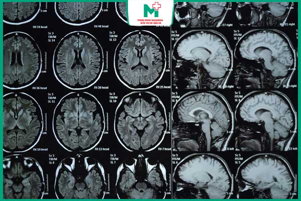 chụp mri chẩn đoán giang mai