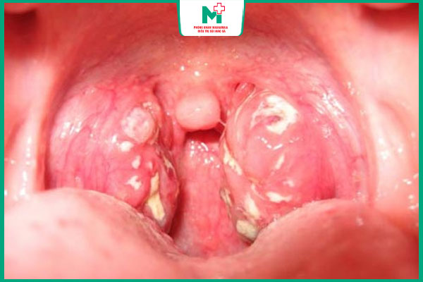 đặc điểm bệnh lậu ở họng