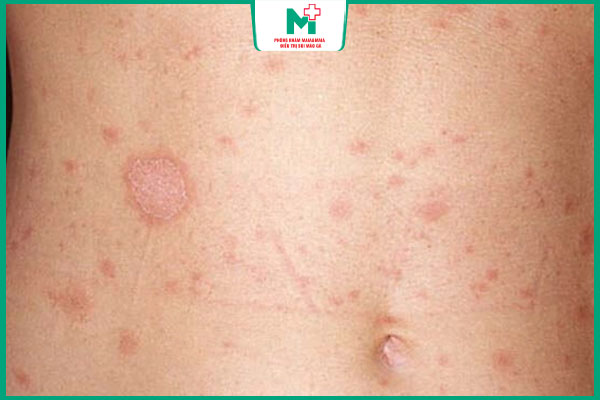 giang mai giai đoạn 1