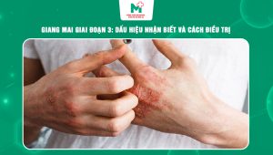 giang mai giai đoạn 3