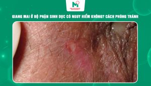Giang mai ở bộ phận sinh dục