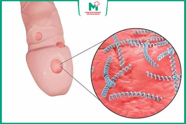 giang mai ở nam giới