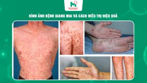 hình ảnh bệnh giang mai