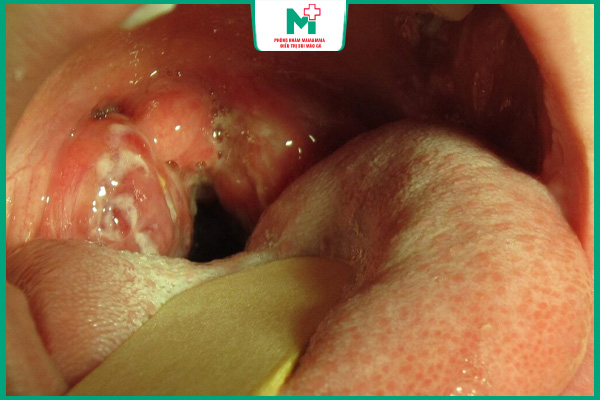 lấy mẫu dịch chẩn đoán chlamydia
