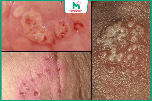 mắc bệnh lậu mãn tính