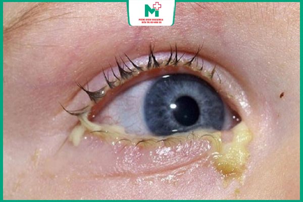 mắt chảy dịch mủ