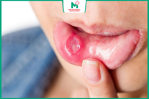 tổn thương do lậu