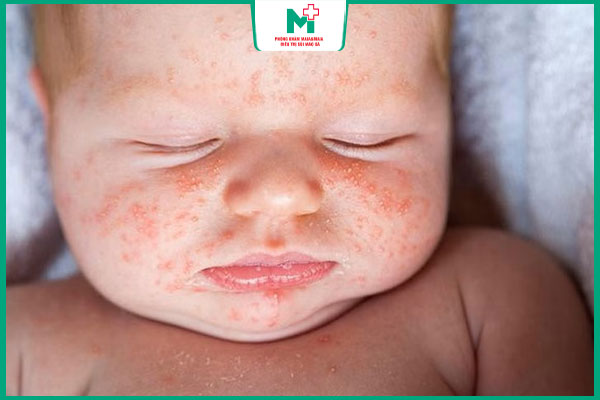 trẻ sơ sinh bị viêm da