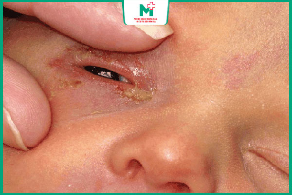 trẻ sơ sinh sưng mí mắt