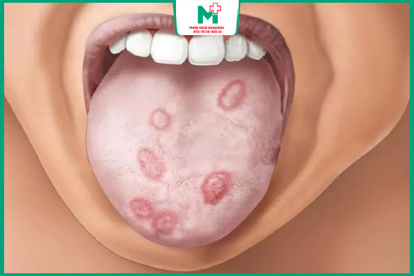 vét loét giang mai ở lưỡi