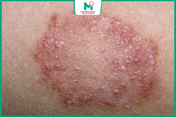 vết loét giang mai