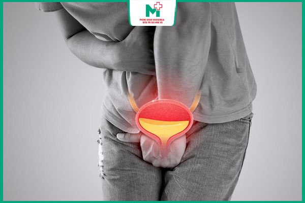 viêm tuyến tiền liệt