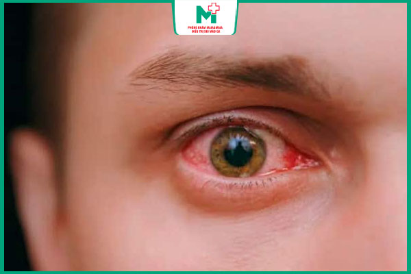 bệnh giang mai ở mắt