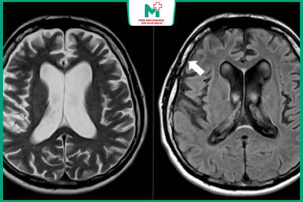 bệnh giang mai thần kinh