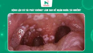 bệnh lậu có tái phát không