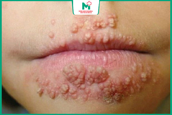 bệnh lậu không tự khỏi