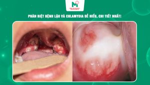bệnh lậu và Chlamydia