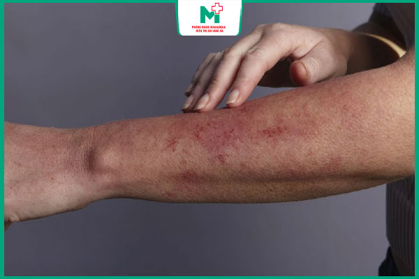 các giai đoạn giang mai