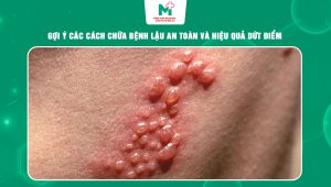 cách chữa bệnh lậu
