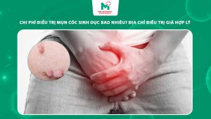 chi phí điều trị mụn cóc sinh dục