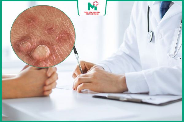 chữa mụn cóc sinh dục