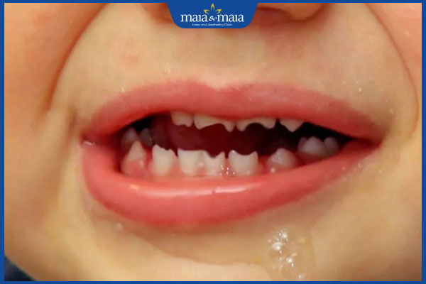 đặc điểm giang mai bẩm sinh muộn