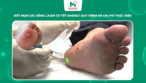 đốt mụn cóc bằng laser