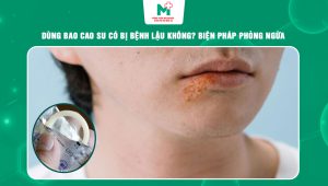 dùng bao cao su có bị bệnh lậu không