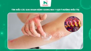 giai đoạn bệnh giang mai
