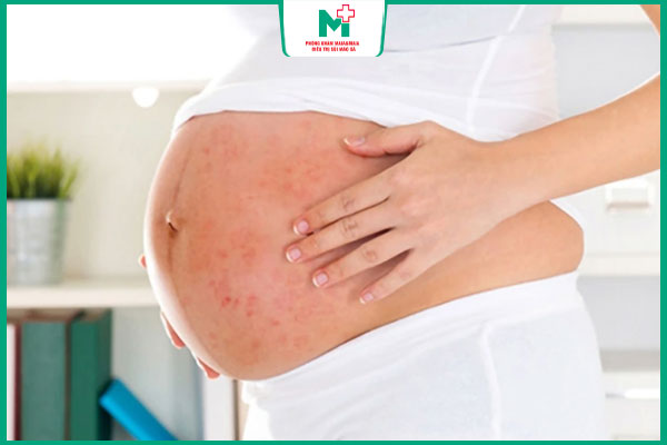 giang mai cuối thai kỳ