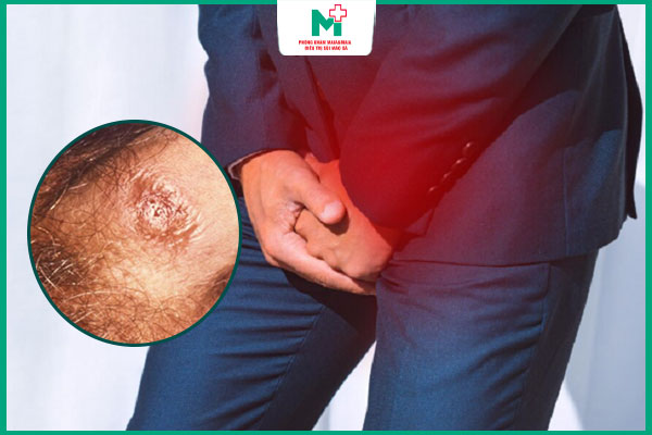 giang mai dương vật