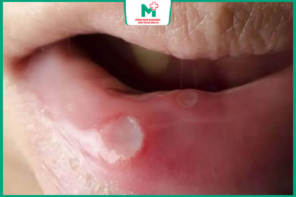 giang mai giai đoạn 1