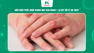 giang mai giai đoạn 1