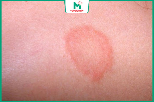 giang mai nguyên phát