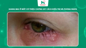 giang mai ở mắt
