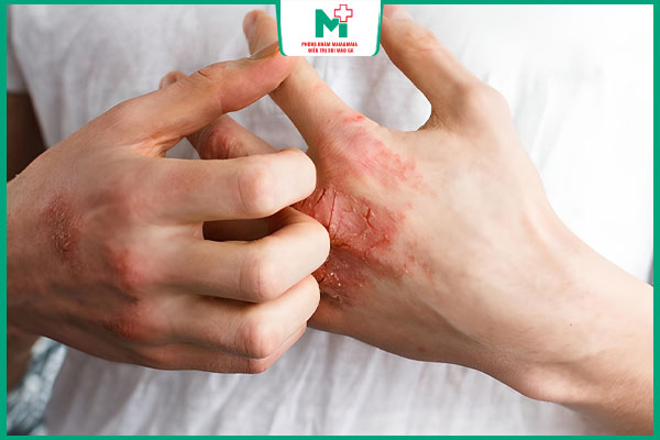 giang mai tiềm ẩn