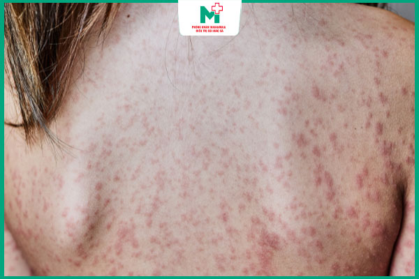 giang mai trên lưng