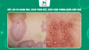 hắc lào và giang mai