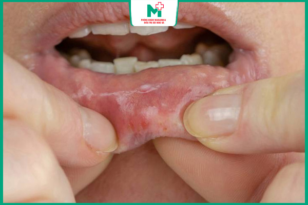 hiệu quả chữa bệnh lậu tại nhà