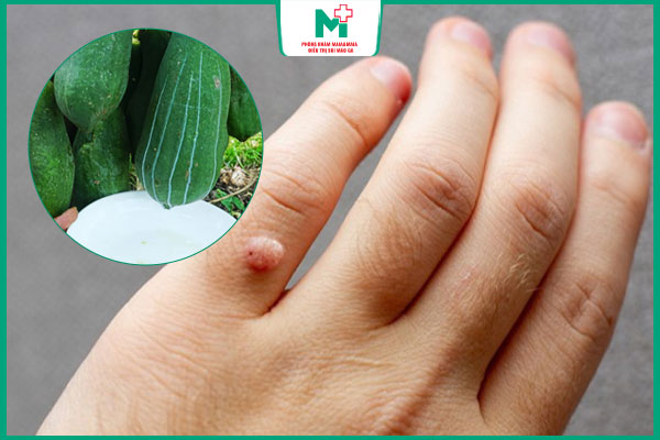 hiệu quả mủ đu đủ chữa mụn cóc