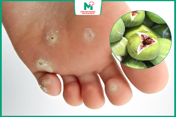 hiệu quả trị mụn cóc bằng sung