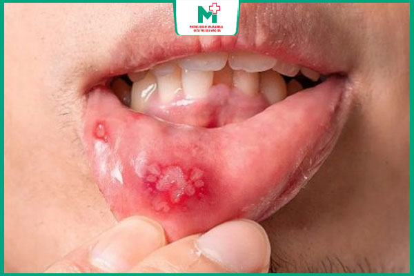 hôn khi môi có vết loét