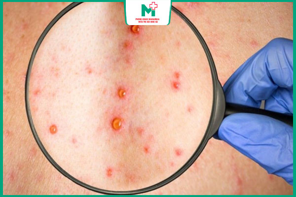 khả năng lây truyền giang mai